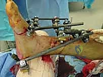 صورة طبية: التثبيت الخارجي لعظم الساق: دليل شامل للمرضى مع الأستاذ الدكتور محمد هطيف