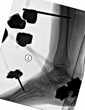 صورة طبية: التثبيت الخارجي لعظم الساق: دليل شامل للمرضى مع الأستاذ الدكتور محمد هطيف