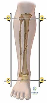 صورة طبية: التثبيت الخارجي لعظم الساق: دليل شامل للمرضى مع الأستاذ الدكتور محمد هطيف