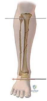 صورة طبية: التثبيت الخارجي لعظم الساق: دليل شامل للمرضى مع الأستاذ الدكتور محمد هطيف