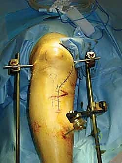 Tibial External Fixation: An Intraoperative Masterclass for Trauma Stabilization