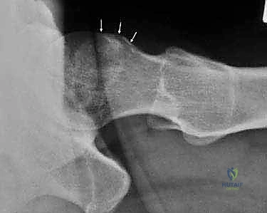 تصوير تخطيطي لانحشار البنسر