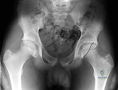 تفاصيل التشريح الدقيق لمفصل الورك