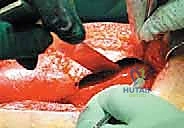 تفاصيل النهج الجراحي الآمن