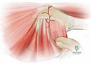 صورة توضيحية لـ خلع الورك الجراحي لعلاج انحشار الفخذ الحقي: دليل شامل من الأستاذ الدكتور محمد هطيف