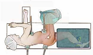 صورة توضيحية لـ خلع الورك الجراحي لعلاج انحشار الفخذ الحقي: دليل شامل من الأستاذ الدكتور محمد هطيف