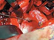 صورة شعاعية قبل الجراحة تظهر التشوه