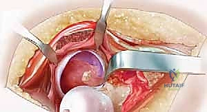 صورة توضيحية لـ خلع الورك الجراحي لعلاج انحشار الفخذ الحقي: دليل شامل من الأستاذ الدكتور محمد هطيف