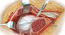 تجهيز المريض وبداية الشق الجراحي