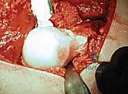 صورة طبية: خلع الورك الجراحي لعلاج انحشار الفخذ الحقي: دليل شامل من الأستاذ الدكتور محمد هطيف