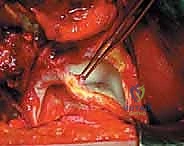 صورة توضيحية لـ خلع الورك الجراحي لعلاج انحشار الفخذ الحقي: دليل شامل من الأستاذ الدكتور محمد هطيف