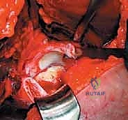 صورة توضيحية لـ خلع الورك الجراحي لعلاج انحشار الفخذ الحقي: دليل شامل من الأستاذ الدكتور محمد هطيف