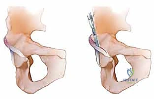 صورة توضيحية لـ خلع الورك الجراحي لعلاج انحشار الفخذ الحقي: دليل شامل من الأستاذ الدكتور محمد هطيف