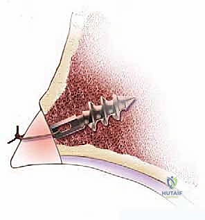 صورة طبية: خلع الورك الجراحي لعلاج انحشار الفخذ الحقي: دليل شامل من الأستاذ الدكتور محمد هطيف