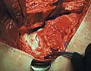 صورة توضيحية لـ خلع الورك الجراحي لعلاج انحشار الفخذ الحقي: دليل شامل من الأستاذ الدكتور محمد هطيف