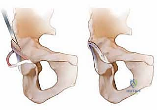 صورة طبية: خلع الورك الجراحي لعلاج انحشار الفخذ الحقي: دليل شامل من الأستاذ الدكتور محمد هطيف