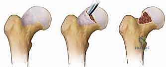 صورة طبية: خلع الورك الجراحي لعلاج انحشار الفخذ الحقي: دليل شامل من الأستاذ الدكتور محمد هطيف