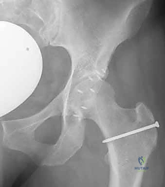 صورة طبية: خلع الورك الجراحي لعلاج انحشار الفخذ الحقي: دليل شامل من الأستاذ الدكتور محمد هطيف