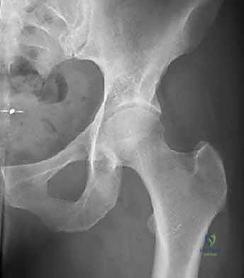 صورة طبية: خلع الورك الجراحي لعلاج انحشار الفخذ الحقي: دليل شامل من الأستاذ الدكتور محمد هطيف