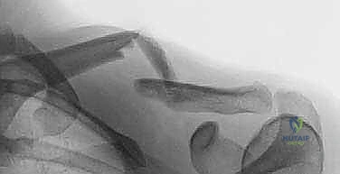 مقطع عرضي يوضح شكل الترقوة