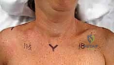 صورة طبية: تثبيت كسور الترقوة داخل النخاع: دليلك الشامل للتعافي الفعال