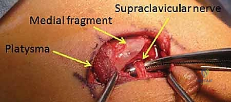 صورة أشعة مقطعية لكسر معقد