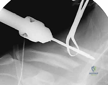 صورة توضيحية لـ تثبيت كسور الترقوة داخل النخاع: دليلك الشامل للتعافي الفعال