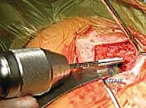 صورة طبية: تثبيت كسور الترقوة داخل النخاع: دليلك الشامل للتعافي الفعال