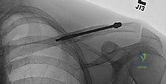 صورة طبية: تثبيت كسور الترقوة داخل النخاع: دليلك الشامل للتعافي الفعال