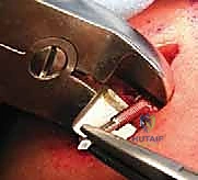 صورة طبية: تثبيت كسور الترقوة داخل النخاع: دليلك الشامل للتعافي الفعال