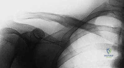 Illustration of fixation of clavicle - Dr. Mohammed Hutaif