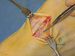 تشريح القدم والأوتار