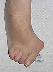 تقييم الزوايا الخاطئة