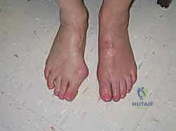 زوايا مفصل المشط السلامي