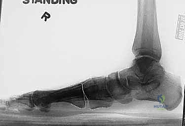 صورة شعاعية تظهر فشل التثبيت