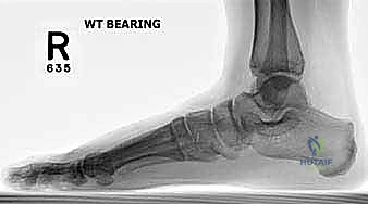 الأشعة السينية للقدم