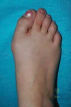 أعراض عودة التشوه