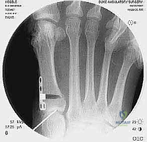 إزالة المسامير السابقة