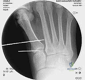 تصوير مقطعي للقدم