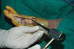 تخطيط جراحي دقيق