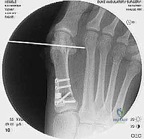 تحرير الأنسجة الرخوة