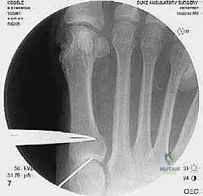 استخدام الفرشات الطبية