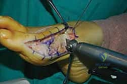 أدوات العلاج التحفظي