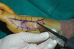 التعامل مع الأنسجة المتندبة