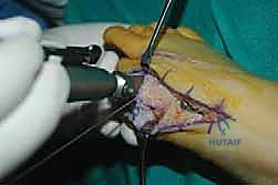 توازن الأربطة