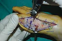 تأثير هشاشة العظام