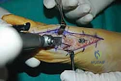 تثبيت مفصل منتصف القدم