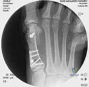 تثبيت العظم بمسامير التيتانيوم