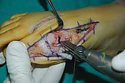 صورة توضيحية لـ جراحة مراجعة إبهام القدم الأروح