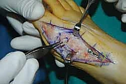 عملية لابيدوس